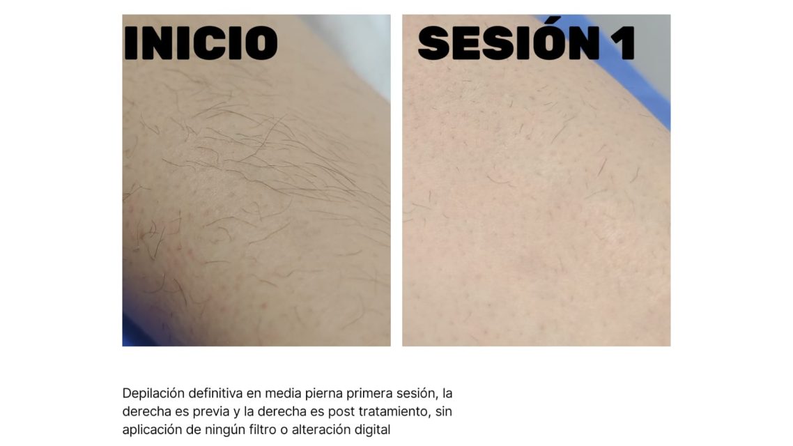 Depilación Studio Gama Comparación de piel antes y después de la primera sesión de tratamiento.